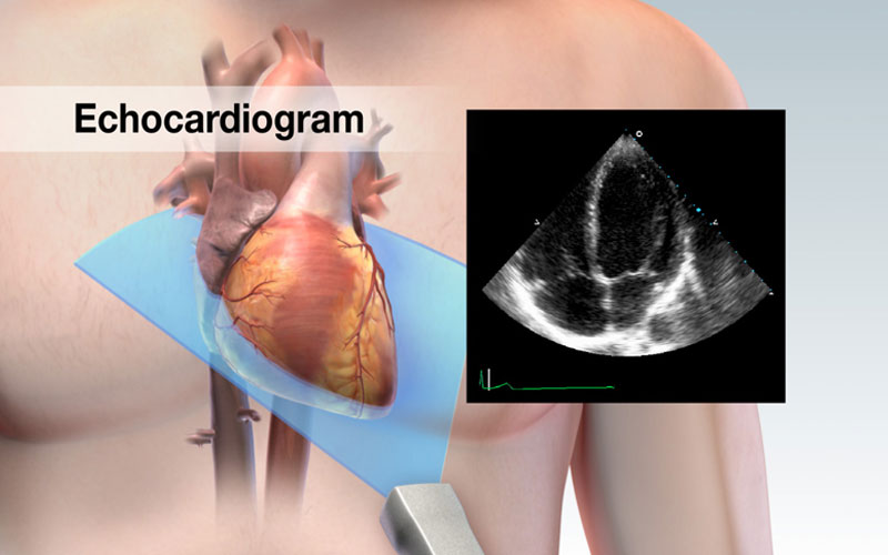 نحوه انجام اکوی قلب