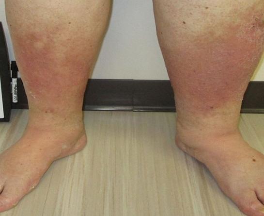 درمان نارسایی وریدی پا