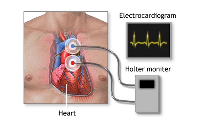 تفسیر نتیجه هولتر قلب