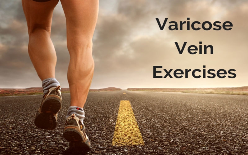 درمان واریس پا با ورزش