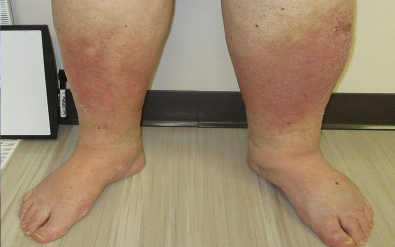 درمان نارسایی وریدی پا