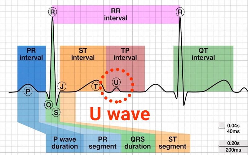 هریک از امواج نوار قلب نشان دهنده چیست