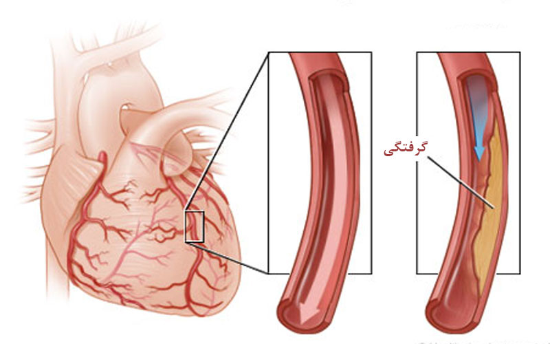 چرا رگ های قلب دچار آسیب می شوند